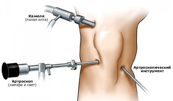 Артроскопия на колянната става