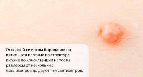 Брадавица на петата: какво да правя?