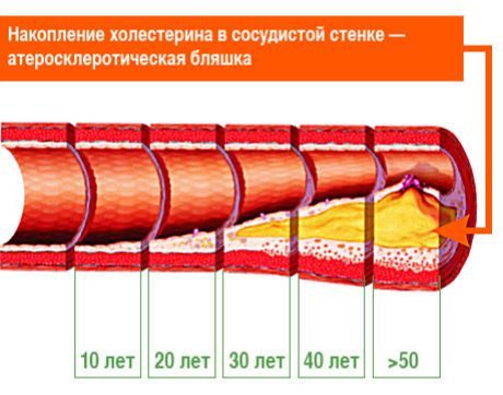 Разкрито е кои атеросклеротични плаки са отговорни за инсулти