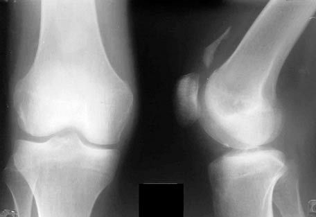 Рентген на колянната става