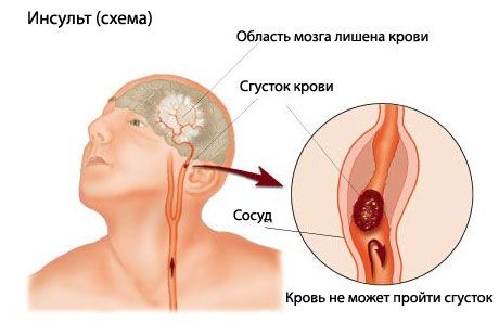 Лесен тест предсказва фатален инсулт
