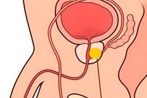 prostatita purulenta tratamentul prostatitei adenom de prostată cu remedii populare